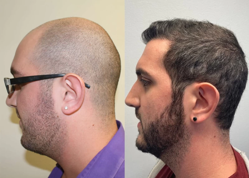 Patient p410 hair transplant before and after left view