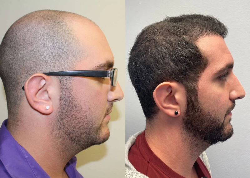 Patient p410 hair transplant before and after right view