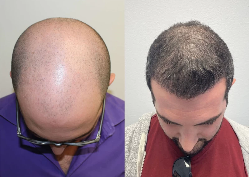 Patient p410 hair transplant before and after tilt view