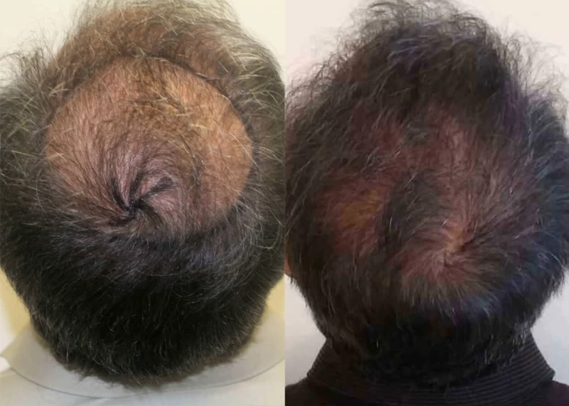 Patient p411 hair transplant before and after crown view