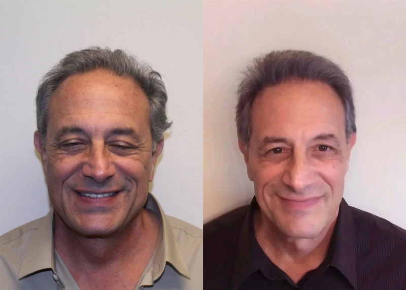Ron Hair Transplant Before and After