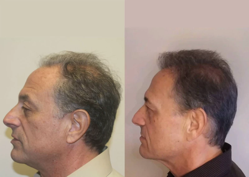 Patient p411 hair transplant before and after left view