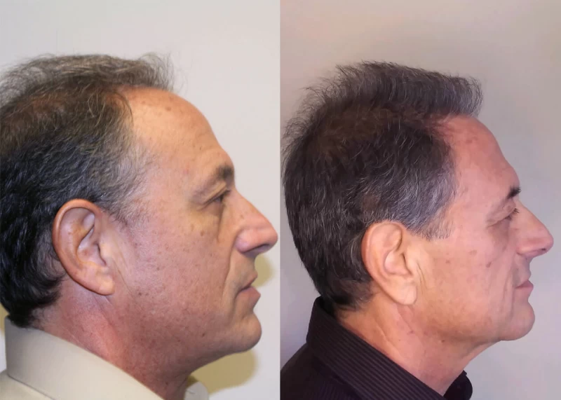 Patient p411 hair transplant before and after right view