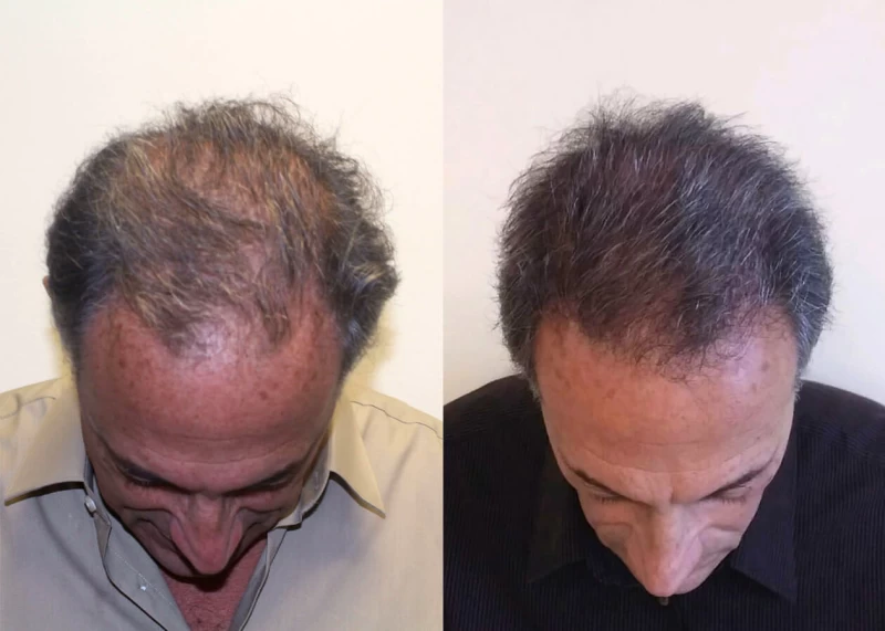 Patient p411 hair transplant before and after tilt view