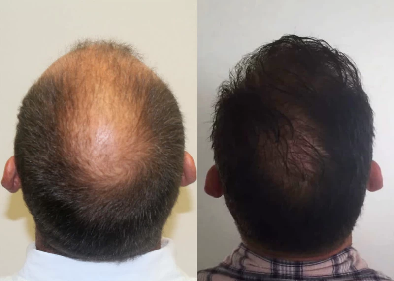 Patient p412 hair transplant before and after crown view