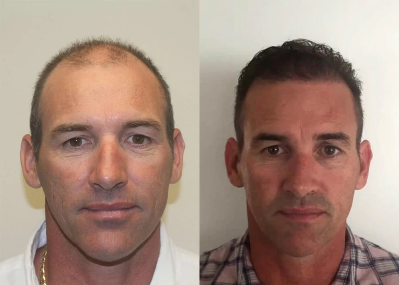 Ric Hair Transplant Before and After