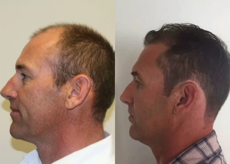 Patient p412 hair transplant before and after left view