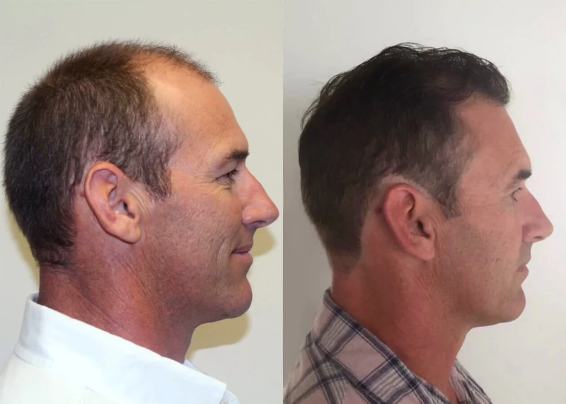 Patient p412 hair transplant before and after right view