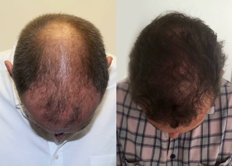 Patient p412 hair transplant before and after tilt view