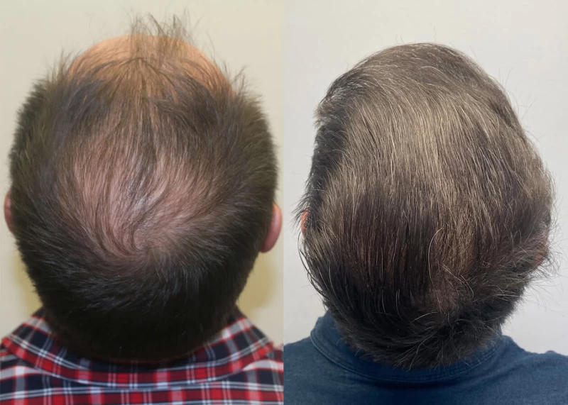Patient p413 hair transplant before and after crown view
