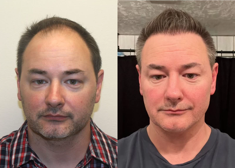 Kyle Hair Transplant Before and After