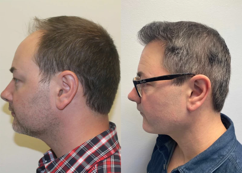 Patient p413 hair transplant before and after left view