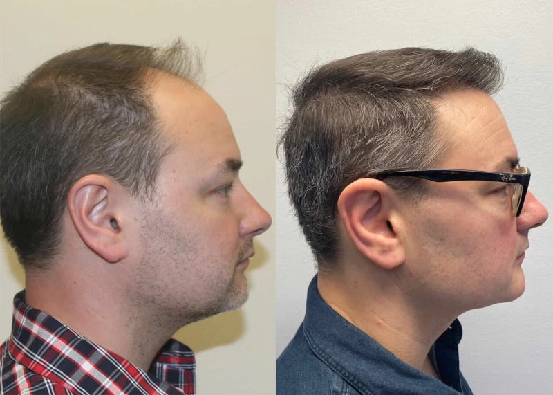 Patient p413 hair transplant before and after right view