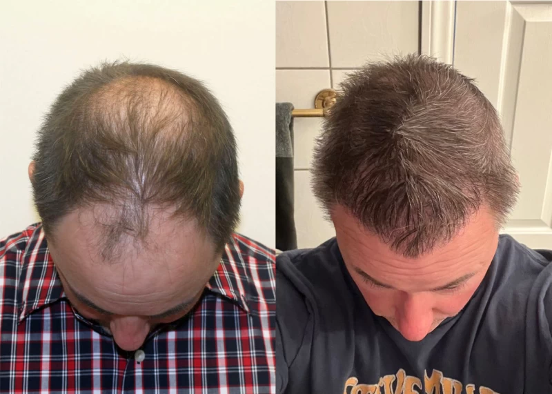 Patient p413 hair transplant before and after tilt view