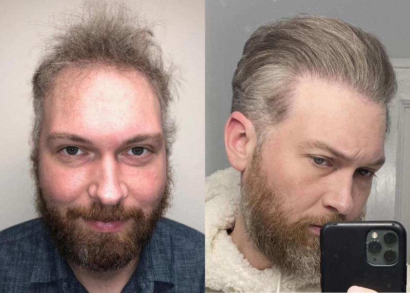 Ryan Hair Transplant Before and After