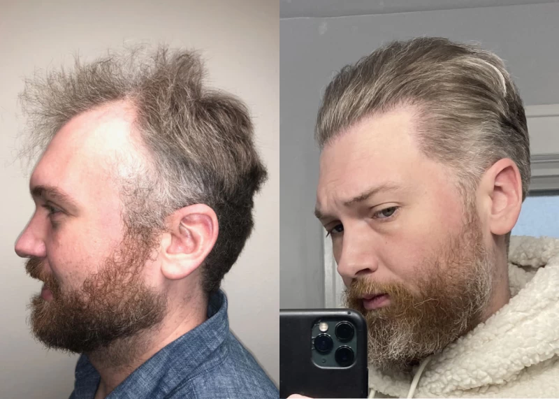 Patient p414 hair transplant before and after left view