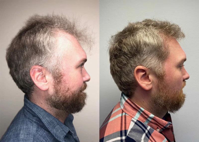 Patient p414 hair transplant before and after right view