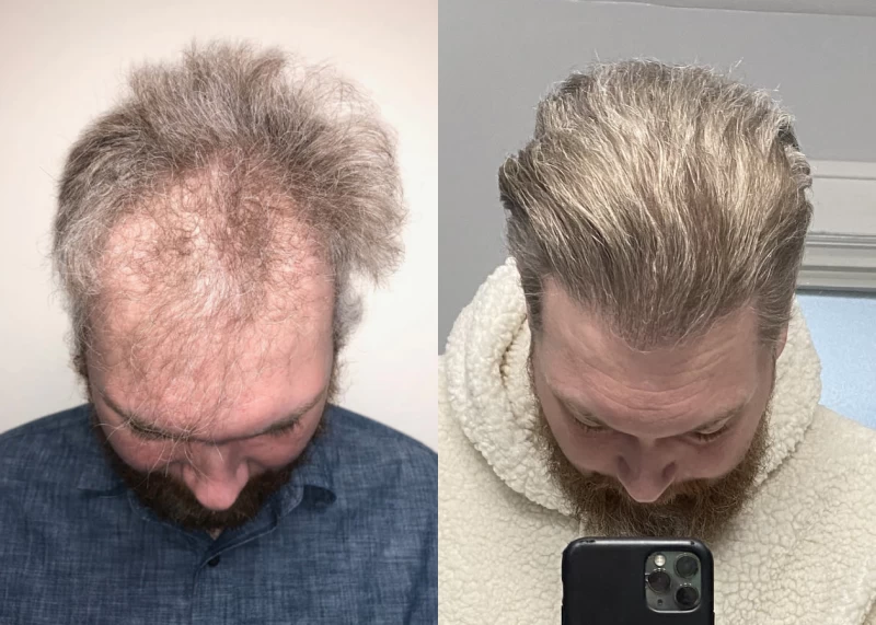 Patient p414 hair transplant before and after tilt view