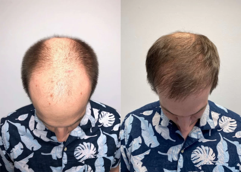 Patient p415 hair transplant before and after crown view