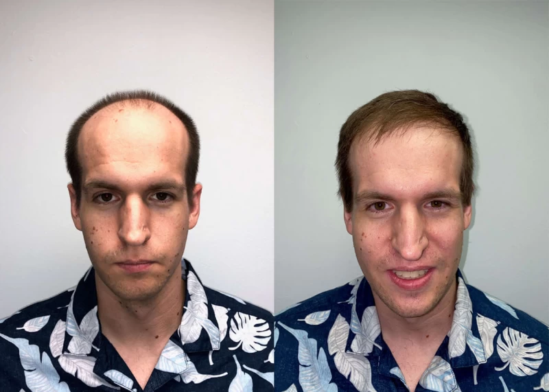 Tim Hair Transplant Before and After
