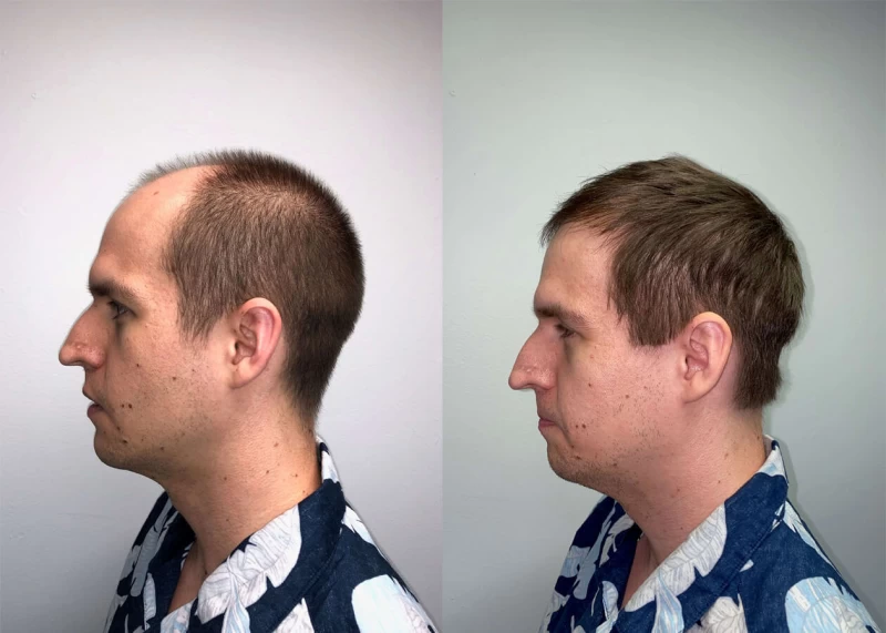 Patient p415 hair transplant before and after left view