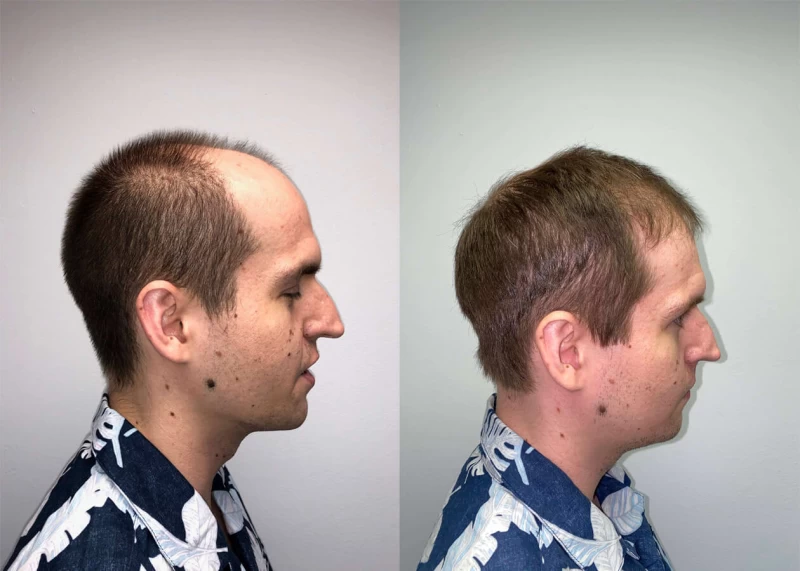 Patient p415 hair transplant before and after right view