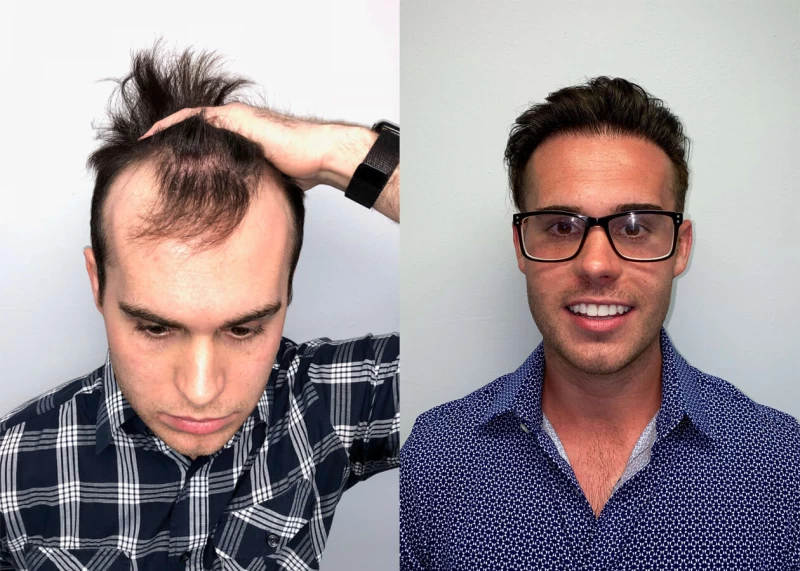 Tim Hair Transplant Before and After