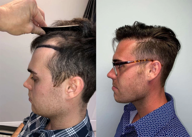 Patient p416 hair transplant before and after left view
