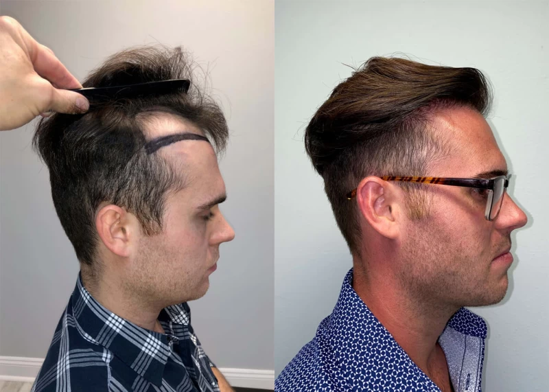 Patient p416 hair transplant before and after right view