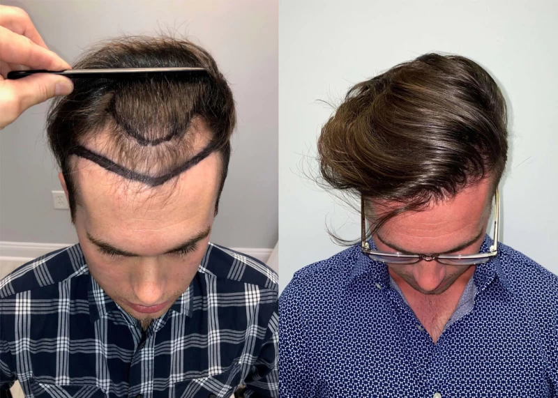 Patient p416 hair transplant before and after tilt view