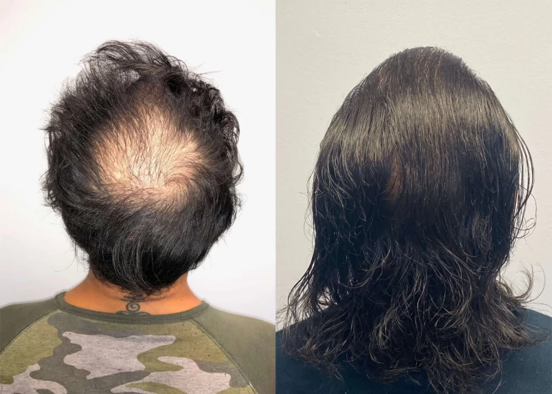 Patient p417 hair transplant before and after crown view