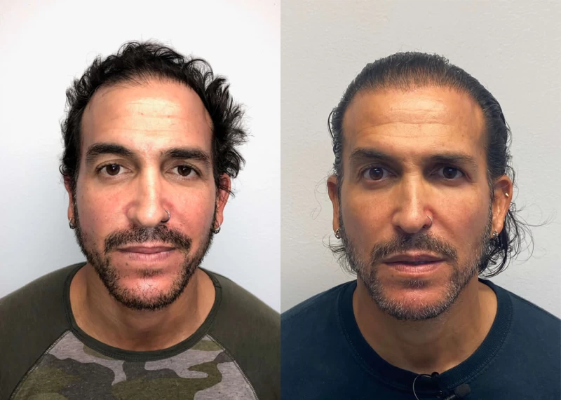 Rolando Hair Transplant Before and After