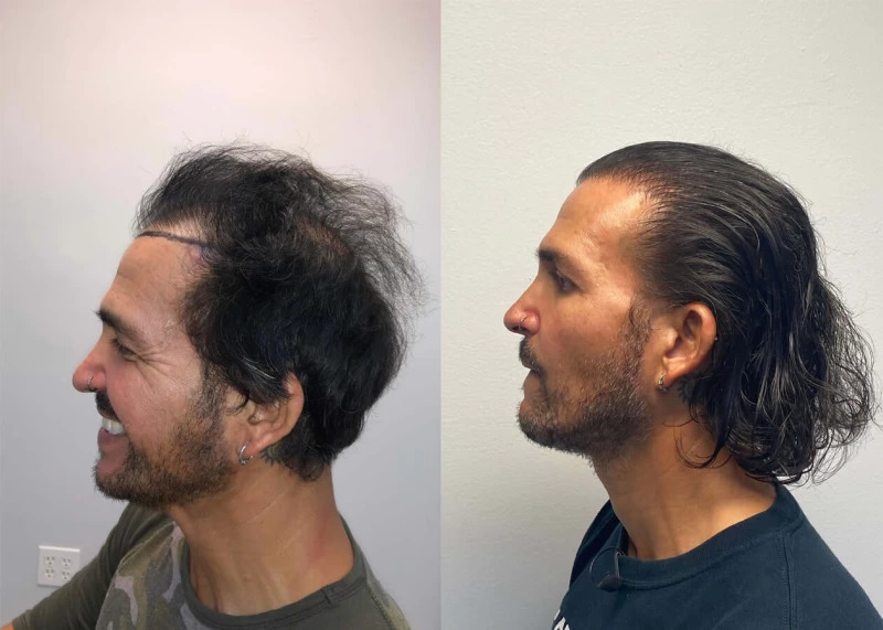 Patient p417 hair transplant before and after left view