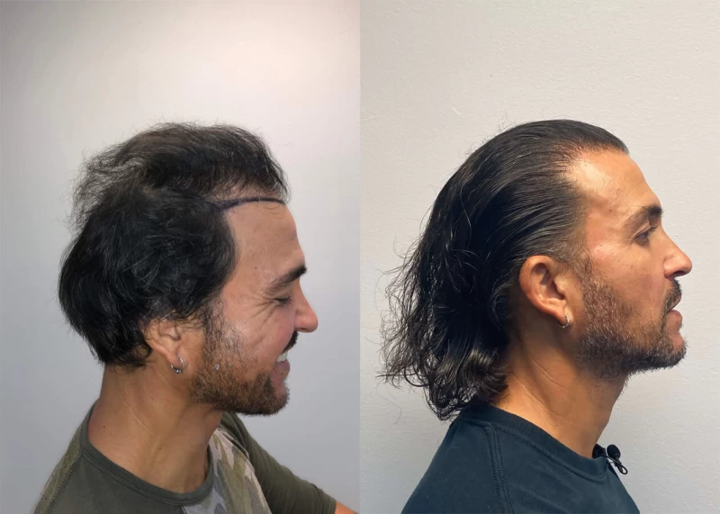 Patient p417 hair transplant before and after right view
