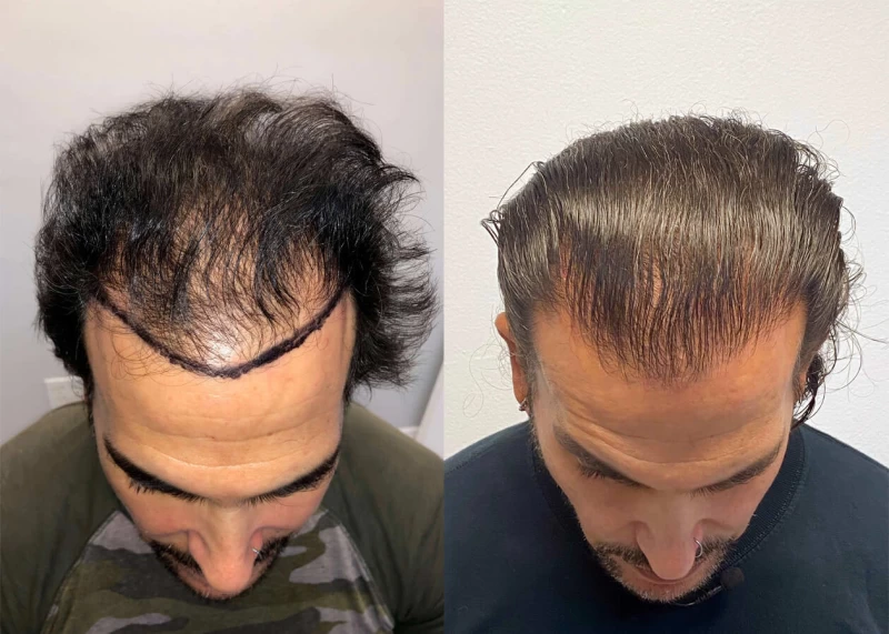 Patient p417 hair transplant before and after tilt view