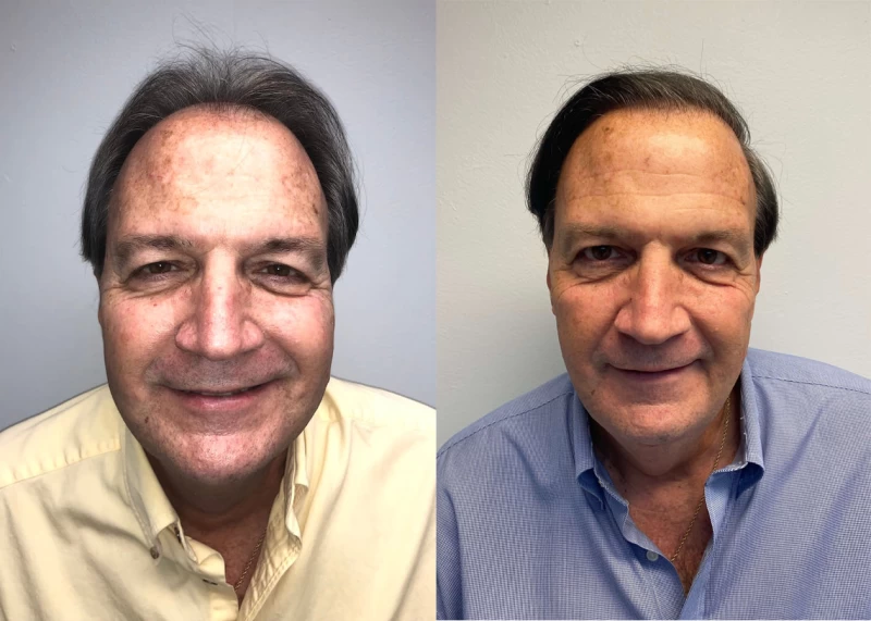 Ed Hair Transplant Before and After