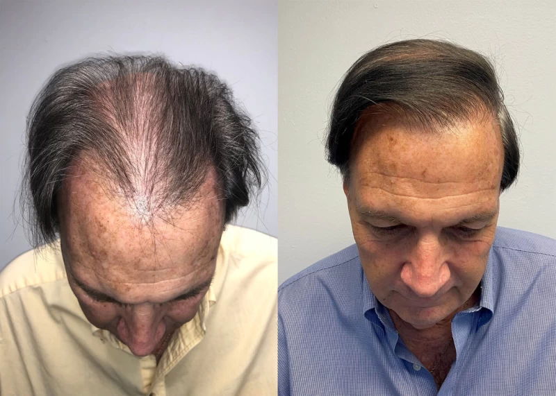 Patient p418 hair transplant before and after tilt view