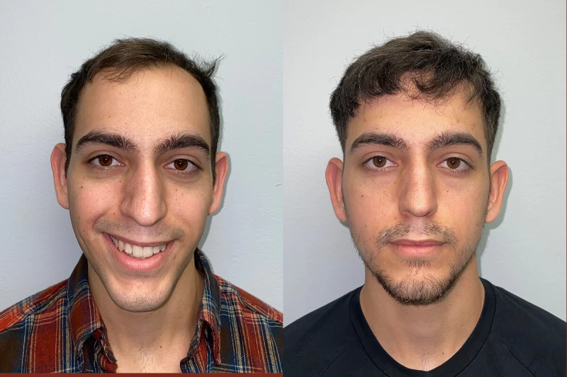 Adrian Hair Transplant Before and After