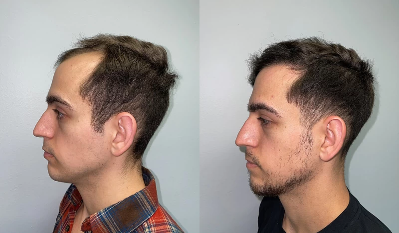 Patient p419 hair transplant before and after left view