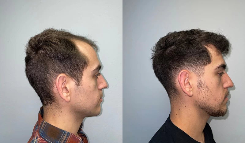 Patient p419 hair transplant before and after right view