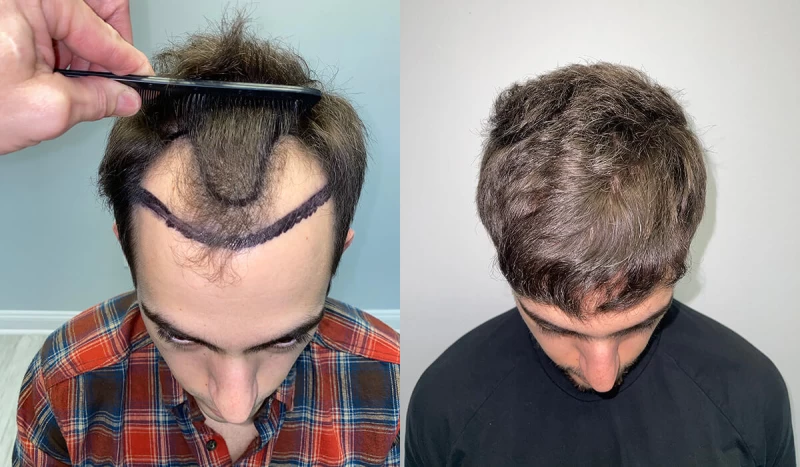Patient p419 hair transplant before and after tilt view