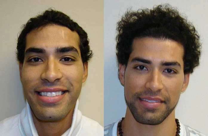 Rolando Hair Transplant Before and After