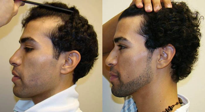Patient p41 hair transplant before and after left view