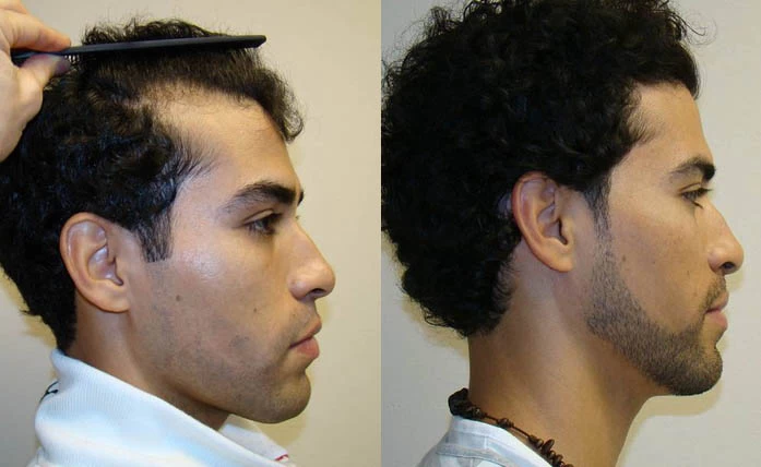 Patient p41 hair transplant before and after right view