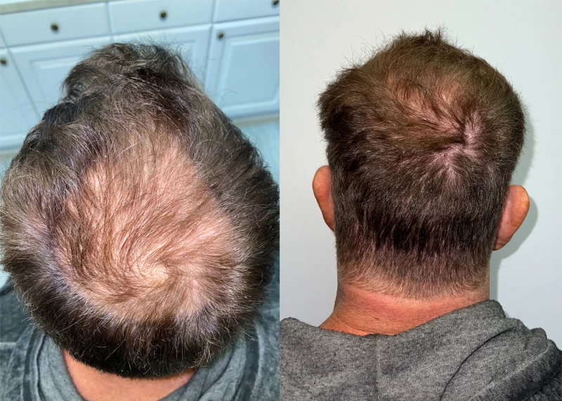 Patient p420 hair transplant before and after crown view