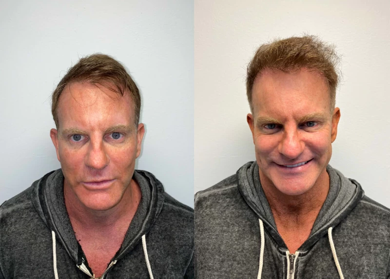 Kevin Hair Transplant Before and After