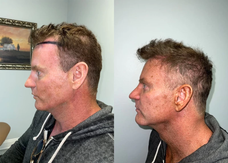 Patient p420 hair transplant before and after left view