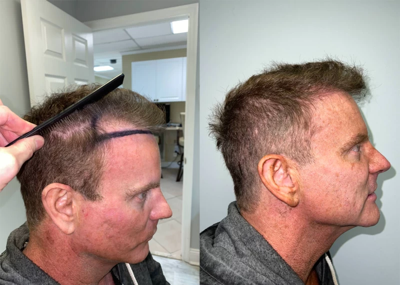 Patient p420 hair transplant before and after right view