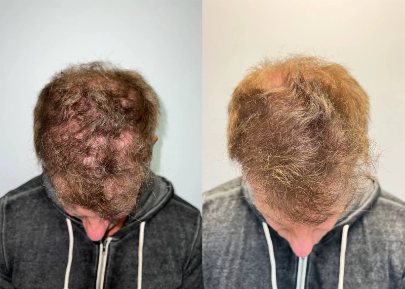 Patient p420 hair transplant before and after tilt view