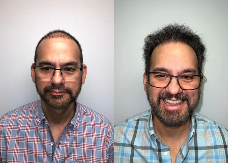 Patient Chris corrective hair transplant results